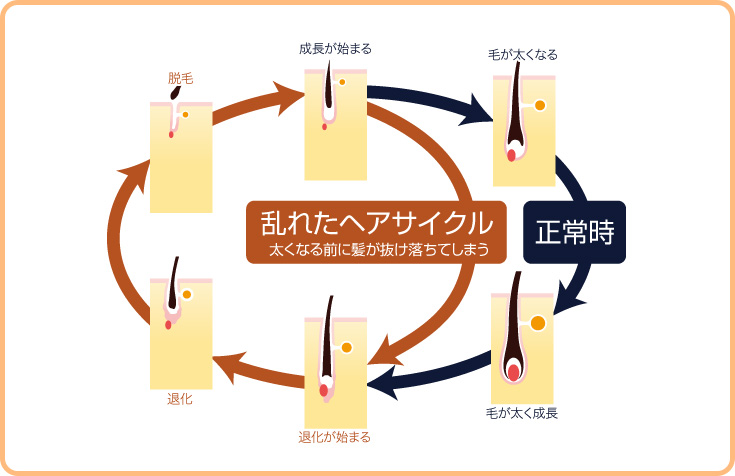 乱れたヘアサイクル 太くなる前に髪が抜け落ちてしまう 正常時→毛が太く成長→退化が始まる→退化→脱毛→成長が始まる→毛が太くなる